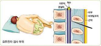 요추천자검사준비 목적자세간호 뇌척수액결과해석 합병증 대조천자 신경계공부