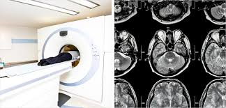 성인간호학 방사선 CT PET검사목적 뇌스캔 도플러 조영술 검사전후간호