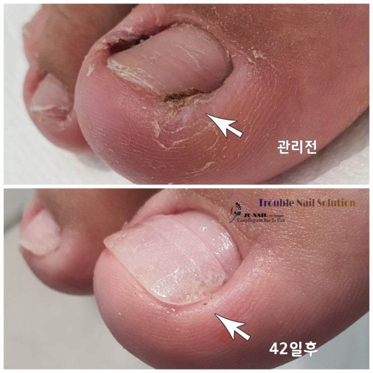 발톱이 아파서 계속 파기만하셨다구요? 염증이생겨 걷기가 힘드시다구요? 발톱수술없이 관리받은 후기/성남수원수지보정동백죽전동/주네일/무좀파고드는내향성발톱손톱변형전문점 발톱이 아파서 계속 파기만하셨다구요? 염증이생겨 걷기가 힘드시다구요? 발톱수술없이 관리받은 후기/성남수원수지보정동백죽전동/주네일/무좀파고드는내향성발톱손톱변형전문점