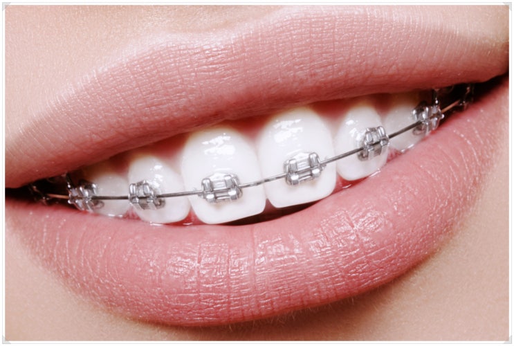 벌어진앞니교정 치료? 14년 차 치과의사가 설명합니다.