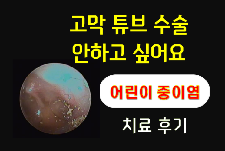 "고막튜브 수술 안하면 안되요?" 5세 아이 -  중이염 수술없이 치료 후기