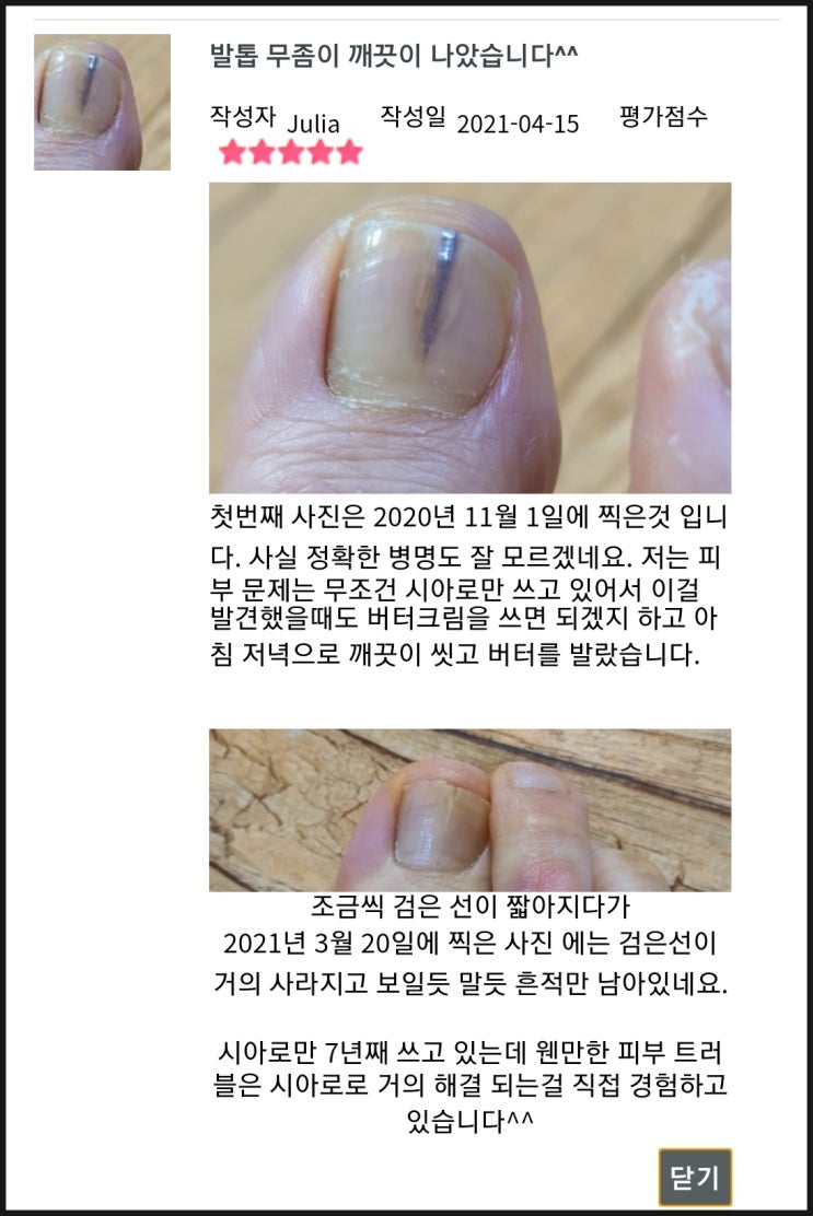  엄지발톱무좀 약안바르고 나았어요^^