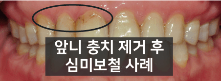 앞니 충치로 인해 변색된 치아 심미보철 크라운 치료 사례
