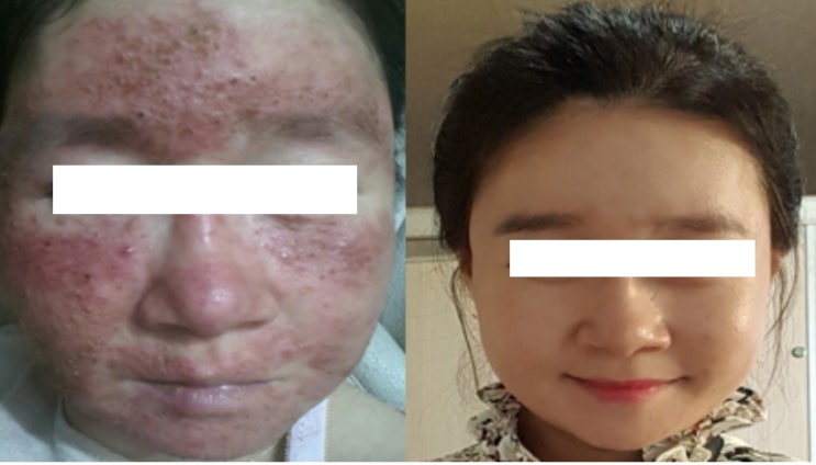  얼굴열감, 얼굴발진 및 따가움 가라앉히는 방법