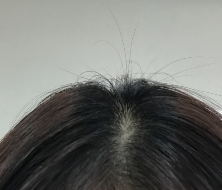 댓츠잔잔앰플 탈모에 정말 찐이다..헐 댓츠잔잔앰플 탈모에 정말 찐이다..헐