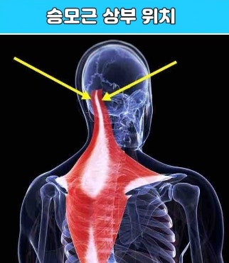 뒷머리 통증(왼쪽 오른쪽), 후두하근 10