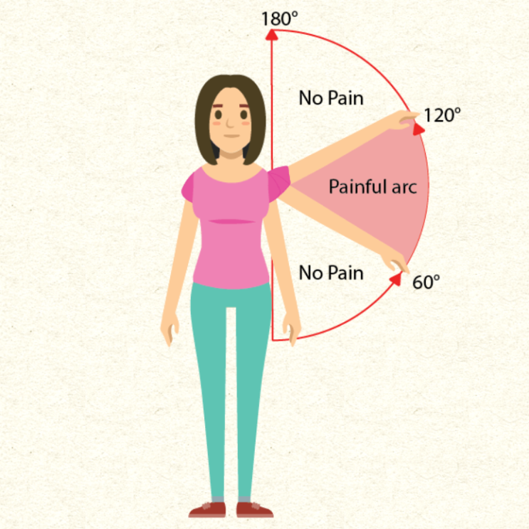 [질병 정보] 어깨 충돌증후군 (Shoulder impingement syndrome) (1) - 어깨를 위로 올릴 때 통증이 있다면? (정의, 진단)