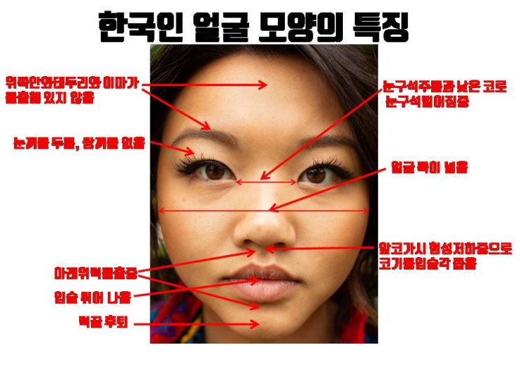  코만 서양인, 얼굴의 다른 부위는 전형적인 한국인, 코수술 결과 예뻐 보일까요?