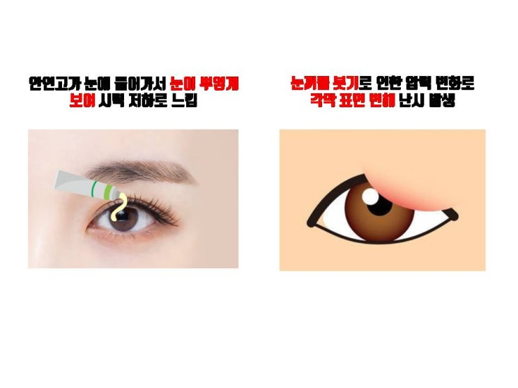  쌍수 후 시력 저하? 쌍수 자체는 시력에 영향을 주지 않는다는데….