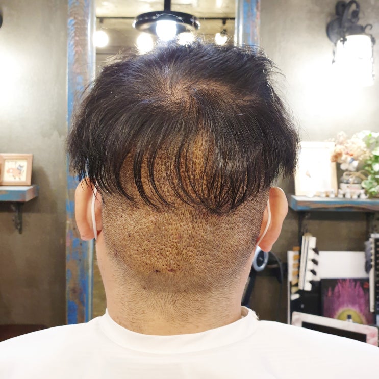  턱수염 모발이식 뒷머리는?