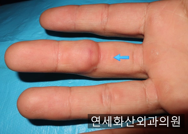 [송파 피부종양 수술] 손가락에 1