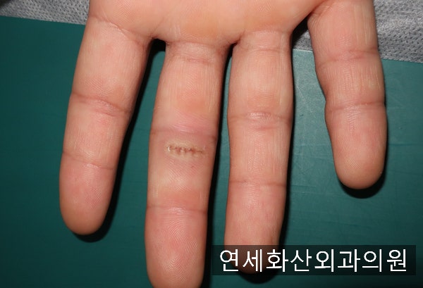 [송파 피부종양 수술] 손가락에 4