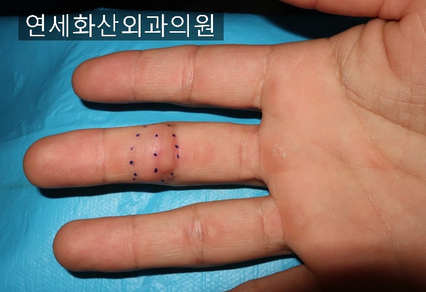 [송파 피부종양 수술] 손가락에 3