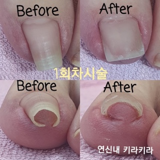  은평구 내성발톱,은평구 발톱무좀,연신내 내성발톱,연신내 발톱무좀.(문제성발 토탈케어.연신내 키라키라)