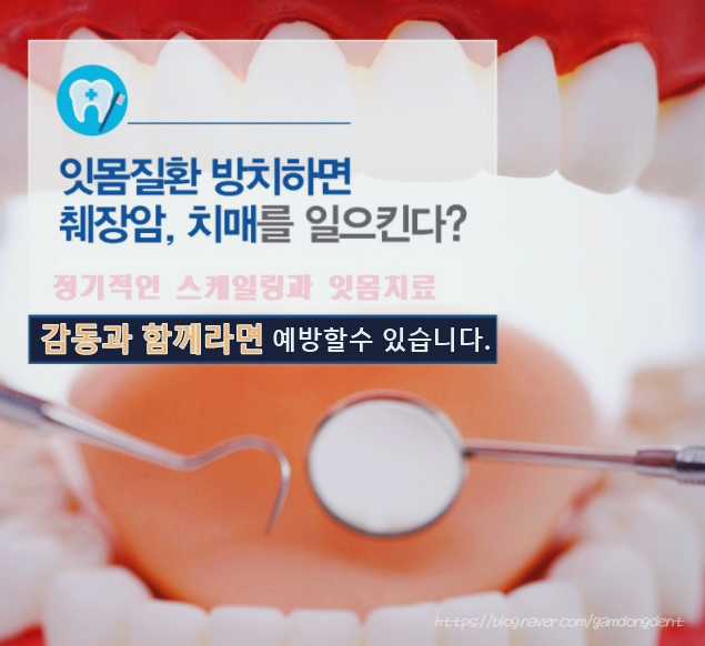  치아 관리를 제대로 못 하면 치매까지 걸린다는데 사실인가요?