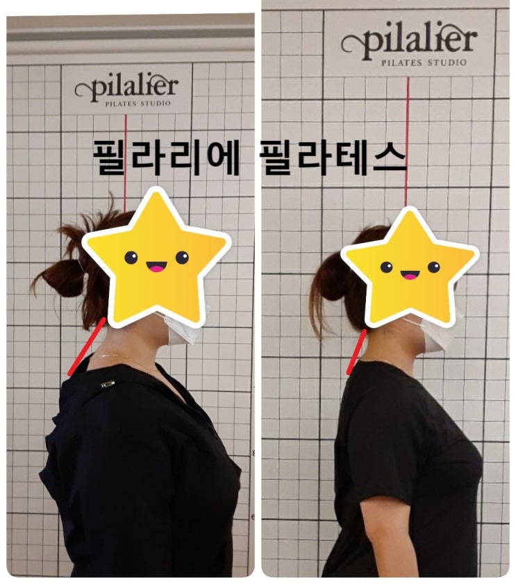  [이수역체형교정] 거북목 굽은등 상지교차증후근 관련 편
