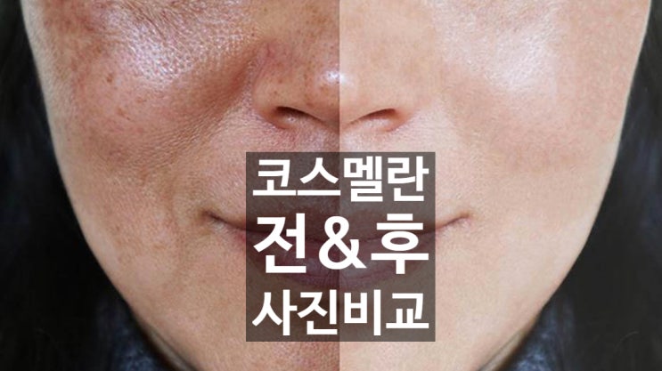  코스멜란 관리 전 & 후 사진 #2