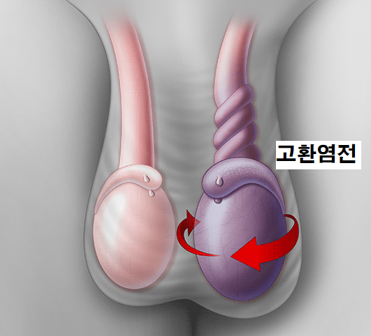 남성의 고환염에 빠른 치료가 필요한 이유