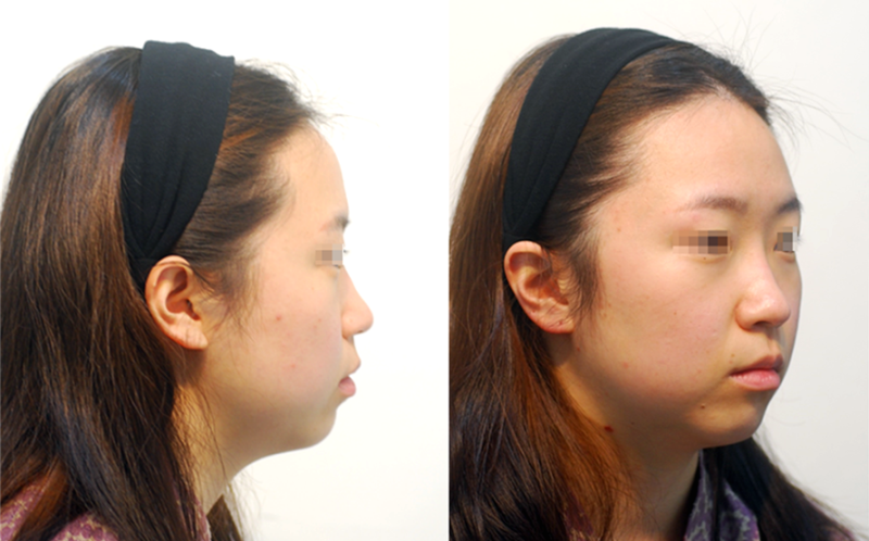 여백수술 지방흡입으로는 안되나 11