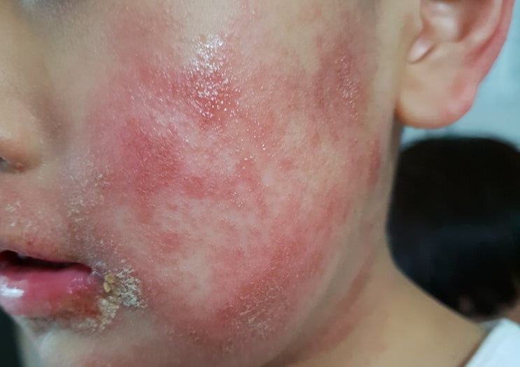  아토피 가려움 다르게 없애보세요