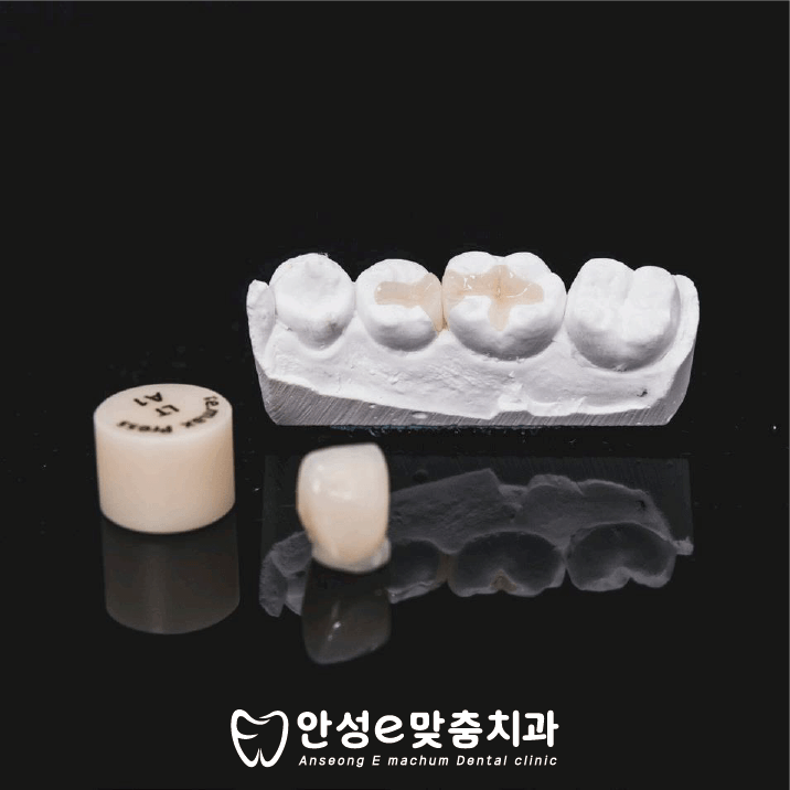  치과 인레이(Inlay) 치료 과정 및 가격
