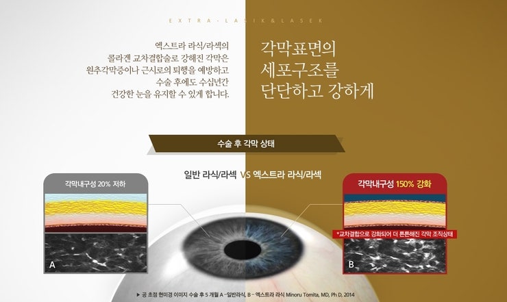 강남라식안과 추천] 각막이 약한 고도근시 맞춤형 수술, 엑스트라라식라섹 : 네이버 블로그