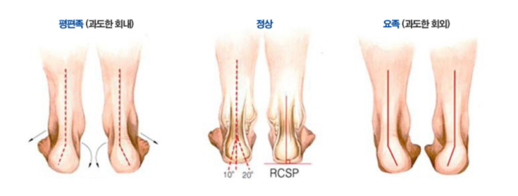  [이수역필라테스] 혹시 나도 평발 ?   평발 & 요족 관련 편