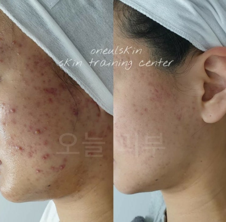 갑자기 피부가 뒤집어졌어요! [오늘피부일기7]