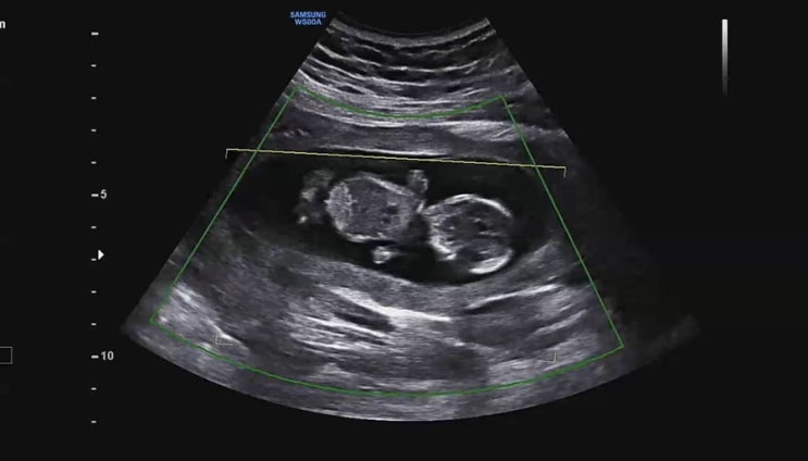  12w6d) 임밍아웃 쪼동이가 찾아왔네