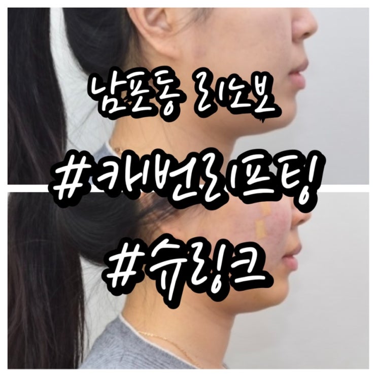  내돈내산/ 남포동 리노보/ 이중턱 뿌수기에 가장 효과적인 시술은?/ 리프팅,슈링크,윤곽주사