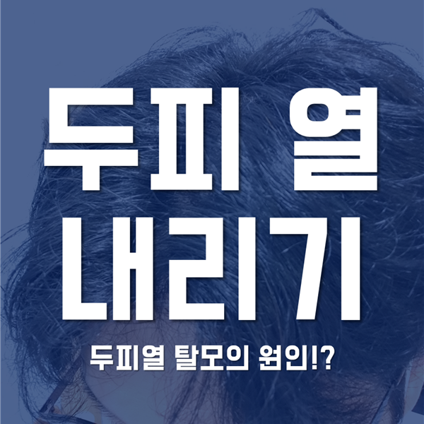  두피열 내리는법 - 두피열 탈모의 원인이 될 수도?