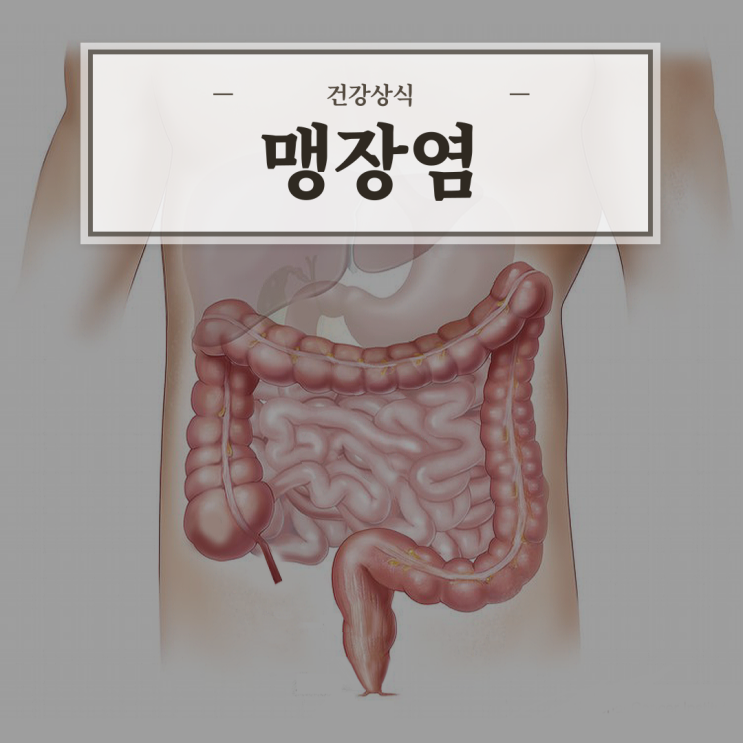  맹장염(충수염), 원인/증상/치료방법 등 간단정리