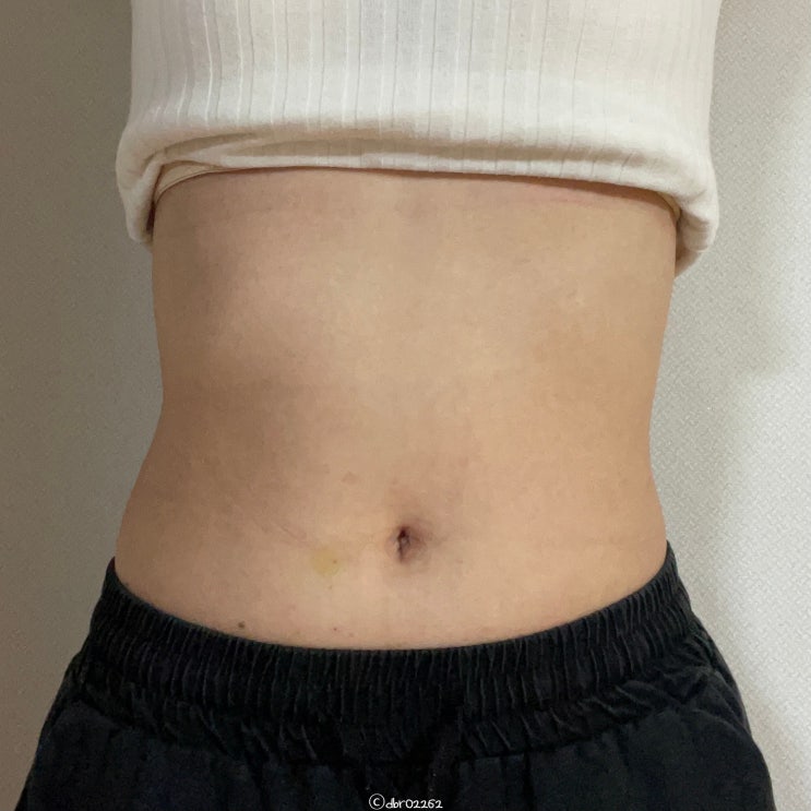 대구피부과에서 뱃살주사 MPL주사 2주차 솔직후기 대구피부과에서 뱃살주사 MPL주사 2주차 솔직후기