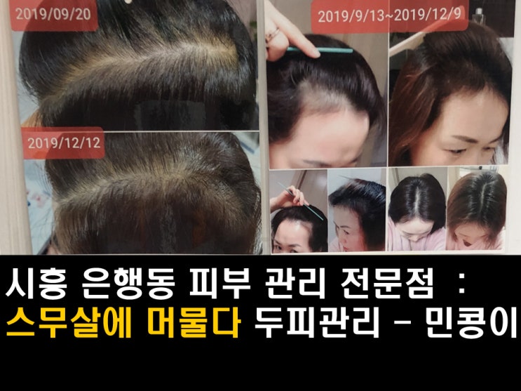  시흥피부관리 <스무살에머물다 시흥은행점> 섬세하고 꼼꼼한 두피관리, 피부·바디케어 - 민콩이