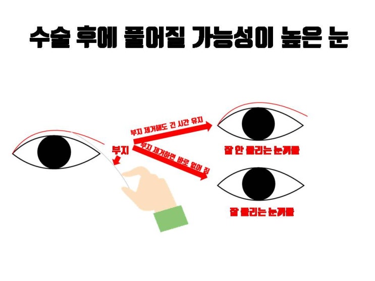  쌍꺼풀 수술과 앞트임을 같이하면 확실히 쌍꺼풀 덜 풀린다!!!