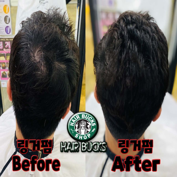  KBS 생생정보통에 방영된 단점커버 !! 링거펌 !! 헤어벅스에서 링거펌 시술 받으세요 ~~!!