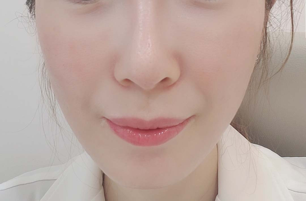  써마지 부작용, 과연?