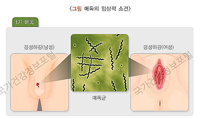 급증하는 매독공포 초기증상 감염경로 잠복기 치료법 예방법 완치 여부 급증하는 매독공포 초기증상 감염경로 잠복기 치료법 예방법 완치 여부