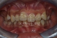  과개교합, 덧니, 돌출 부정교합, 발치교정 증례입니다.                          [교정] 고운미소치과 신촌1호점 (신촌점)