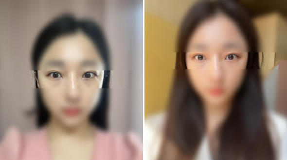  압구정피부과 눈밑필러로 다크서클 고민해결!