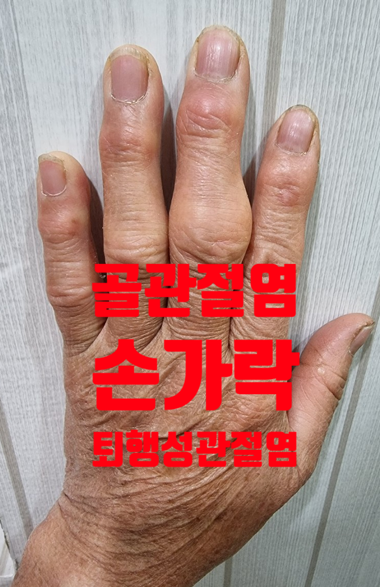 손가락 관절염, 손가락 통증 - 퇴행성 골관절염 - 안양 맑은숲 엔 한의원