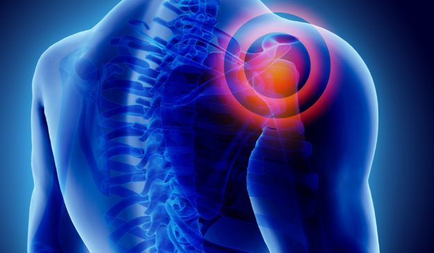  [질병 정보] 어깨 충돌증후군 (Shoulder impingement syndrome) (2) - 아픈 어깨, 어떻게 치료해야 할까?