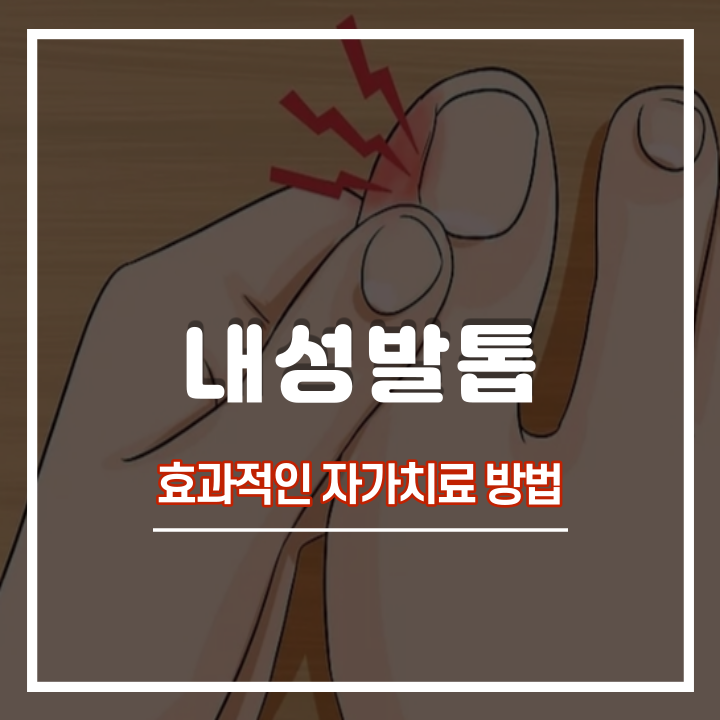  내성발톱 증상 및 원인과 자가치료 : 내향성발톱 교정기, 테이프 효과