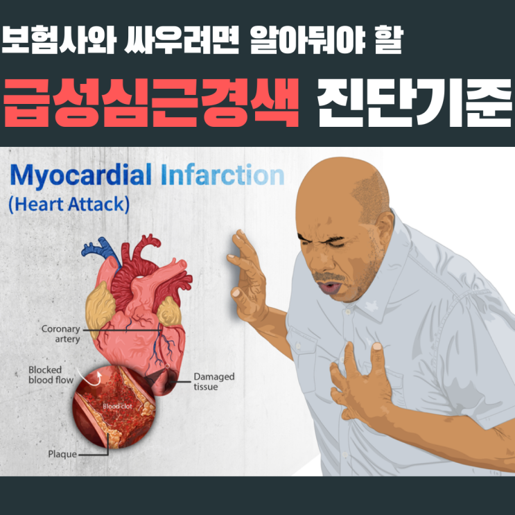 보험사와 싸우려면 알아둬야 할 "급성심근경색 진단기준"