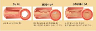 간호학 협심증약물종류 니트로글리세린 질산염제제 적응증부작용 용량투여경로 간호학 협심증약물종류 니트로글리세린 질산염제제 적응증부작용 용량투여경로
