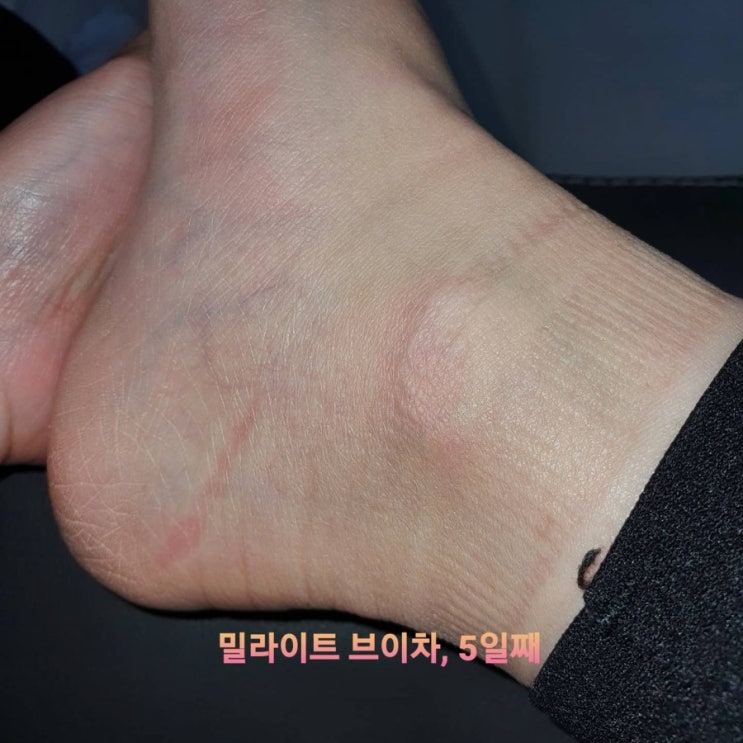  야식먹은 다음날의 부은얼굴 이제 걱정 그만!