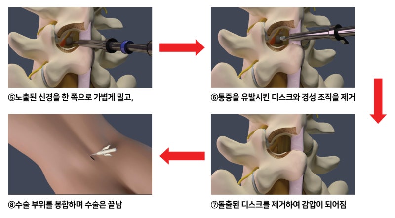인천척추병원, 디스크 내시경 수술로