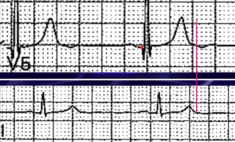 Inverted U waves : highly specific for the presence of heart disease ...