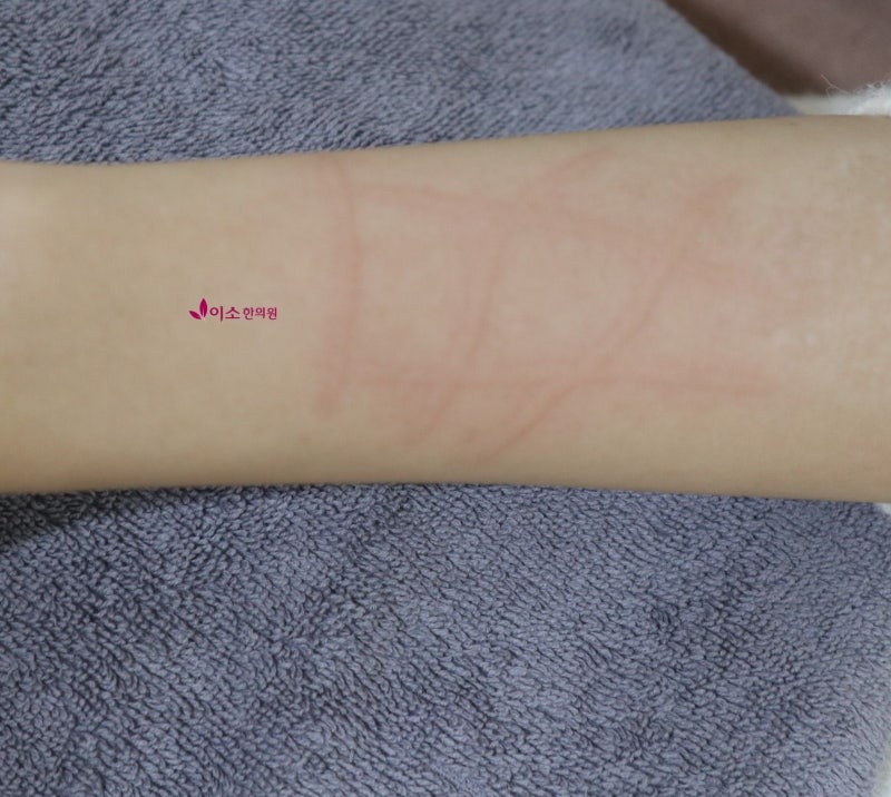 갱년기 여성 피부가 화끈거리고 가려움 피부묘기증