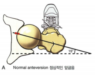  [이수역체형교정] 고관절 전경 과 후경 관련 편